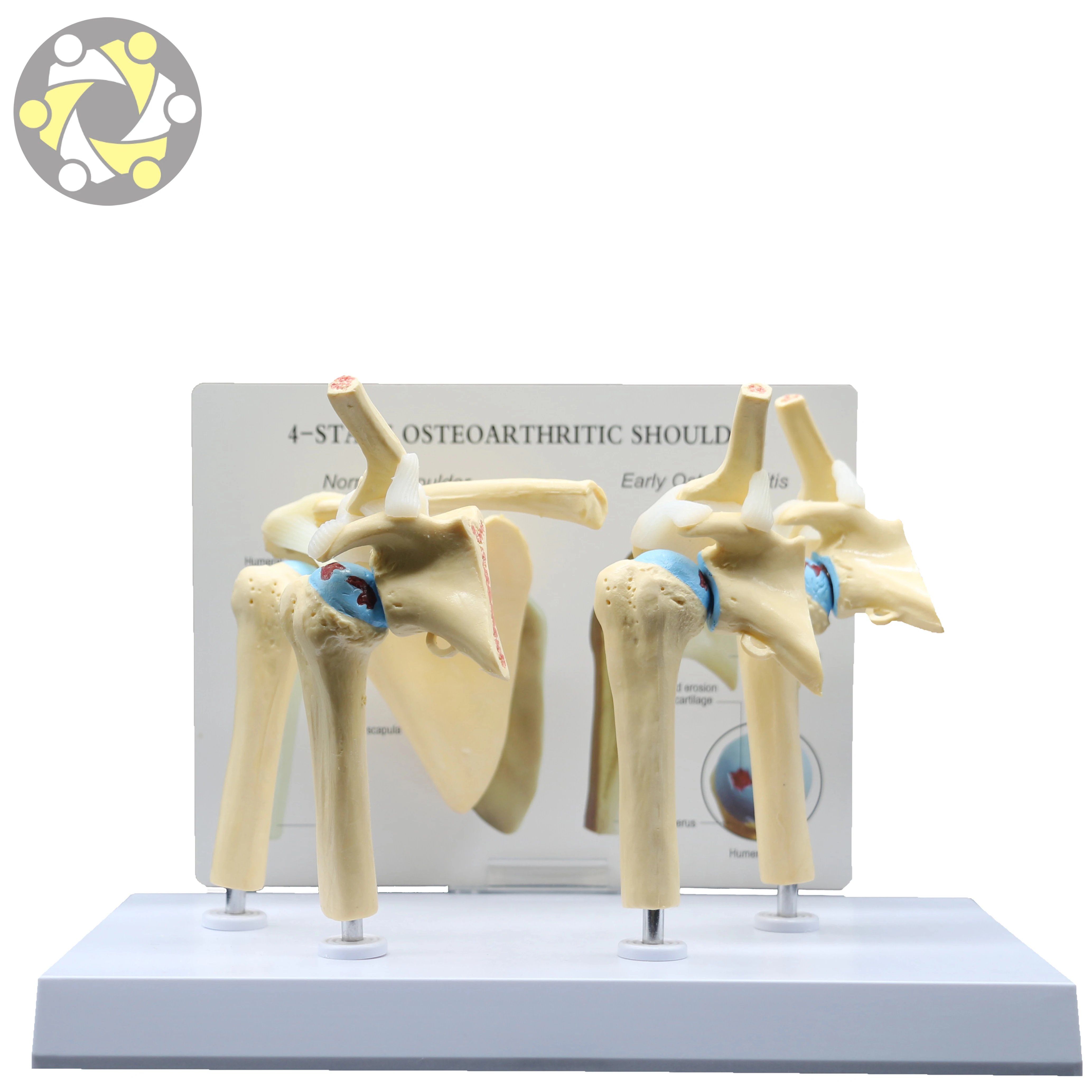 Medical Science Skeleton Model Human Diseased 4 Stage Osteoarthritic Shoulder Model for Teaching
