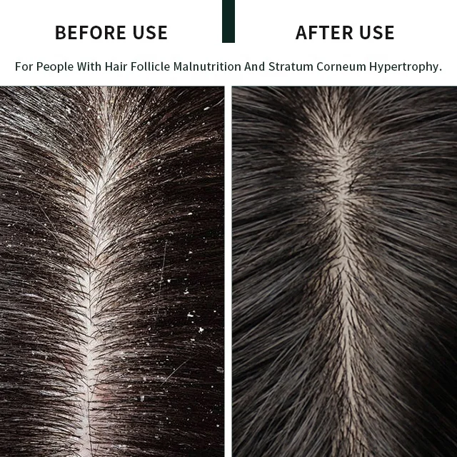 Scalp Cleaning Products Hair Renew Pre Wash Treatment  Hair And Scalp Problems Scalp Head Spa Lotion