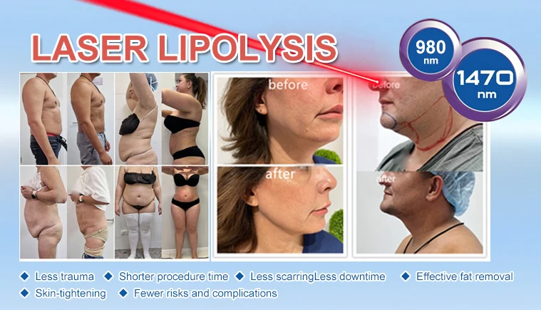 Professional medical 980 laser liposuction laser lipolysis endolaser 1470nm laser fiber face lifting beauty machine