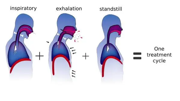 Аппарат для удаления мокроты