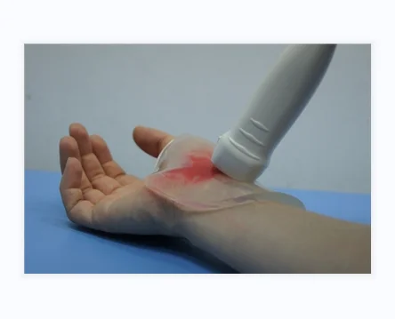 Yafho Hydrogel Ultrasound Gel Pad relieve the hurt of wounds keep a moist environment medical consumables