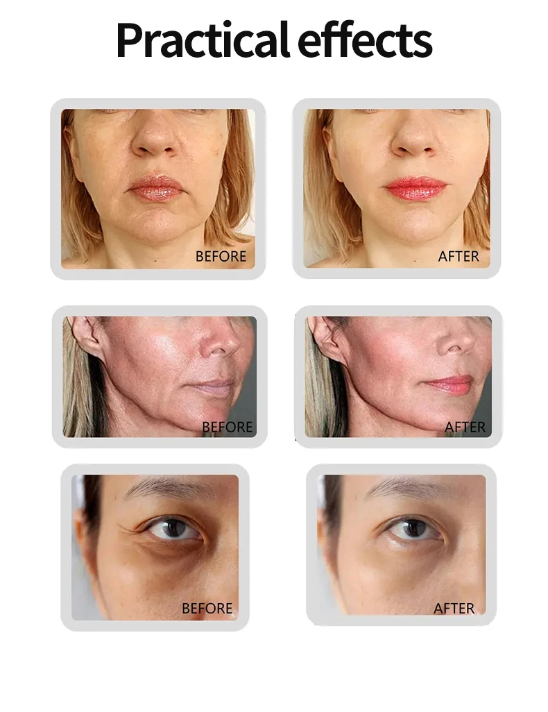 CROWNLIFT 21G 100mm Medical Aesthetics Facial Hilos PDO Korea 4D COG PDO for Facial Lifting PDO Thread korean threads