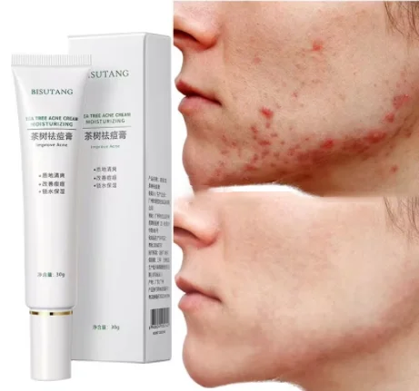 Herbal Acne Removal Face Cream Oil Control Anti-Acne Gel Treatment Acne Mark Skin Care Whitening Eliminate Pimples Facial Cream