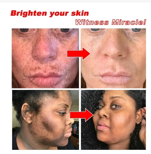 Whitening Cream Repairing Freckle Pigmentation Improving Dark Yellow Smoke Amide Reducing Melasma Facial Whitening Cream