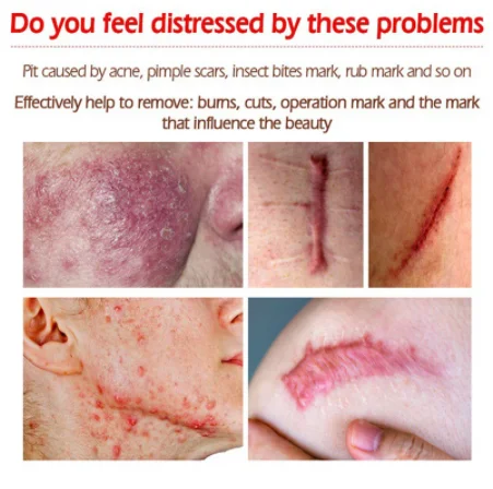 Acne Scar Removal Gel Treatment Surgical Scald Repair Cream Fade Dark Skin Pigmentation Postpartum Whitening Smooth Skin Care