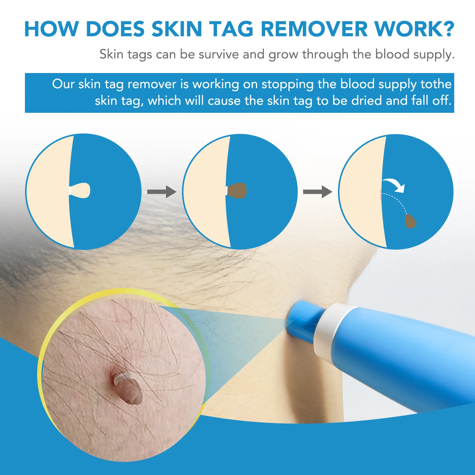 SUFUDUN Factory Skin Wart Tag Remove Kit With Cleansing Swabs for Face Mole Skin Tag and Mole Remover Pen