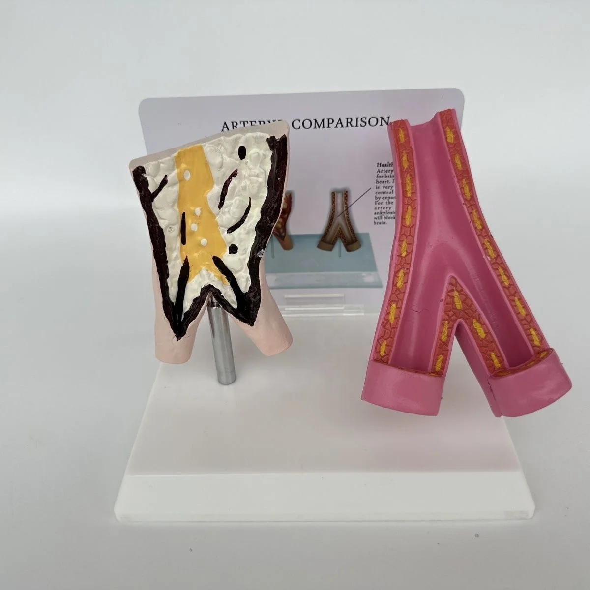 Medical Sciences Comparison Model Between Smoking Blood Vessels and Normal Blood Vessels  Artery Pathology Model