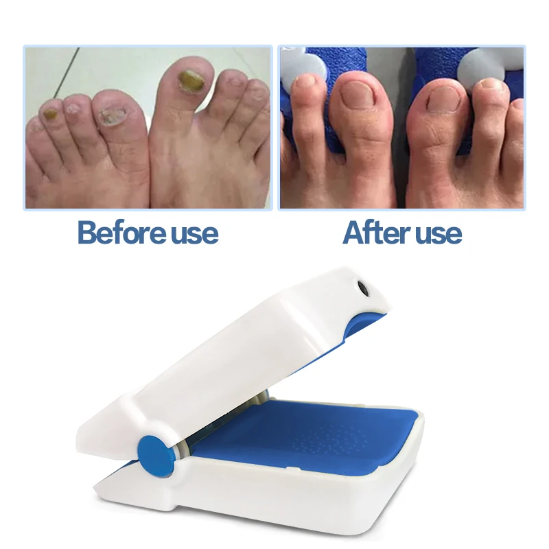 Remedies Home Use Nail Fungus Treatment Toenails Fungal Infection Cleaning Cold Laser Device with No Side Effects LLLT 905nm