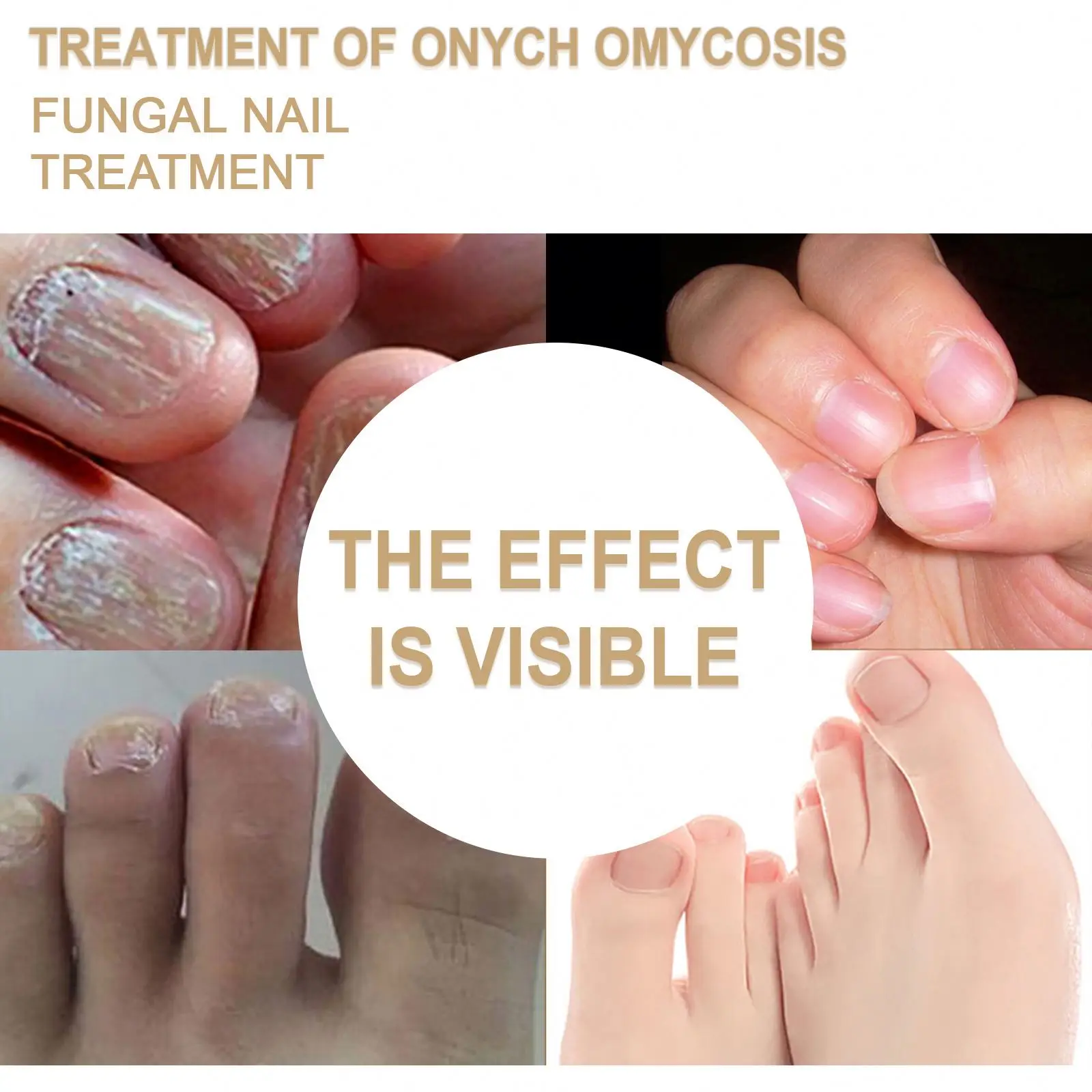 Costom Fungal Nail Repair Spray Nursing Treatment Anti-Infective Paronychia Onychomycosis Care  Foot Nail Fungus Removal Gel