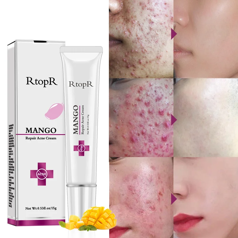 2021 RtopR Mango Organic Pimple Scar Remover Anti Spots Shrink Pores Whitening Acne Removal Cream