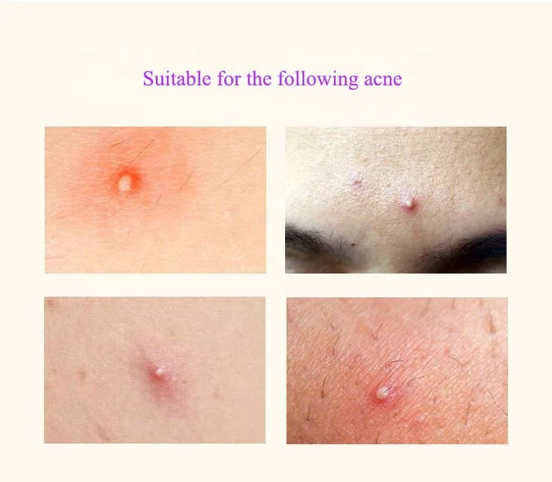 Best Hydrocolloid Acne Pimple Patch on Face Alternative at Home After Moisturizer for Skin Tags, Face and Sensitive Skin