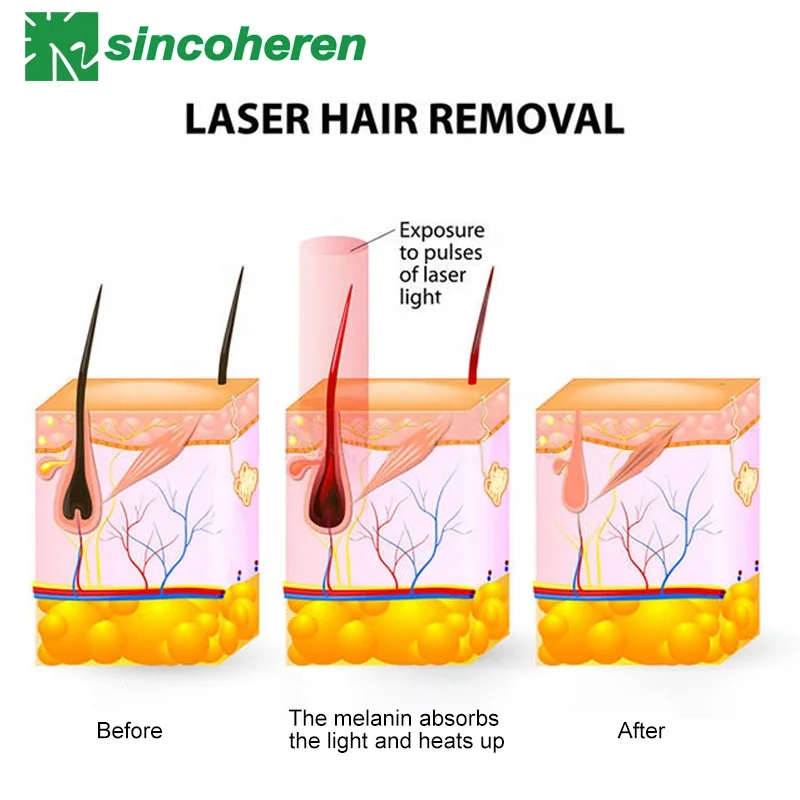 Sincoheren Professional 3 wave 755 808 1064nm diode laser hair removal machine SDL-D