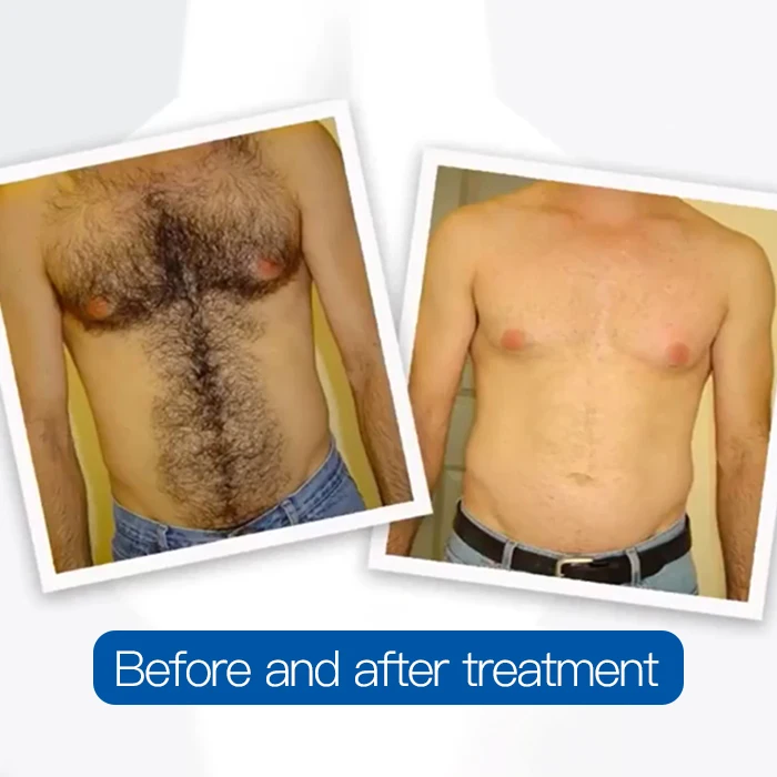 2022 Newest 4K 1000W 1200W 1600W Triple wave  808nm laser diode hair removal/755 8081064 diode laser machine price