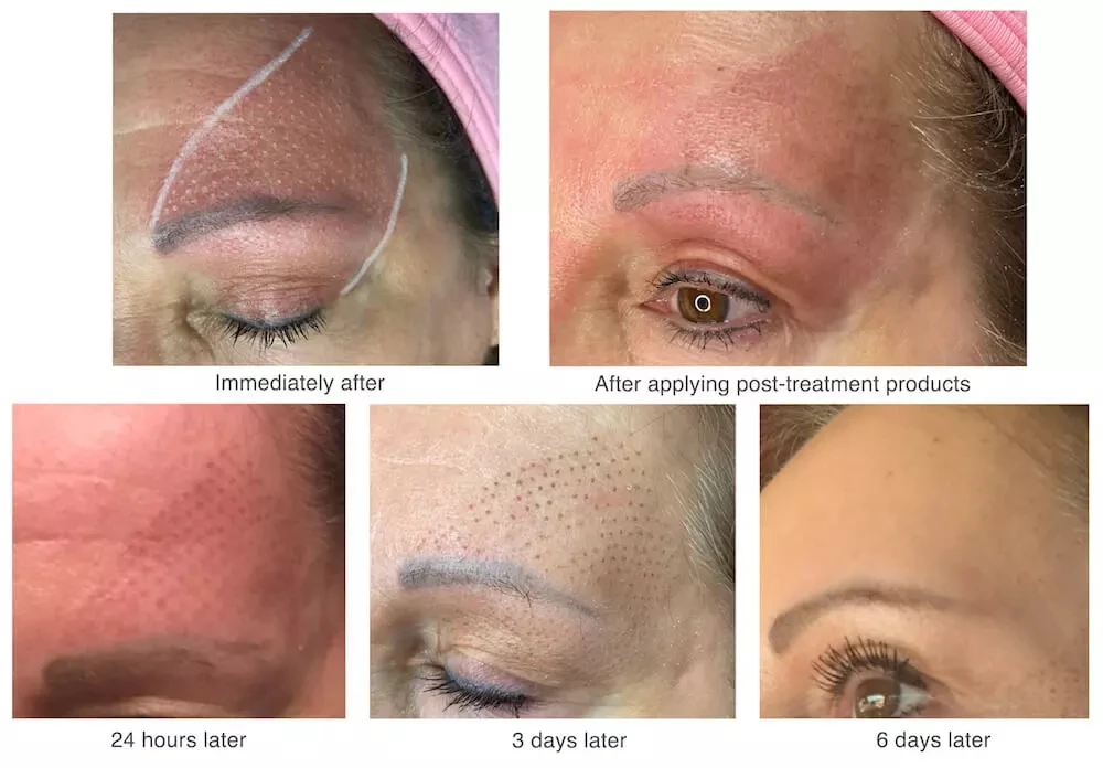 Plaxage Pores mole laser Korea plaxel plus plasmapen fibroblast plasma pen  for eyelid tightening and lifting plasma pen