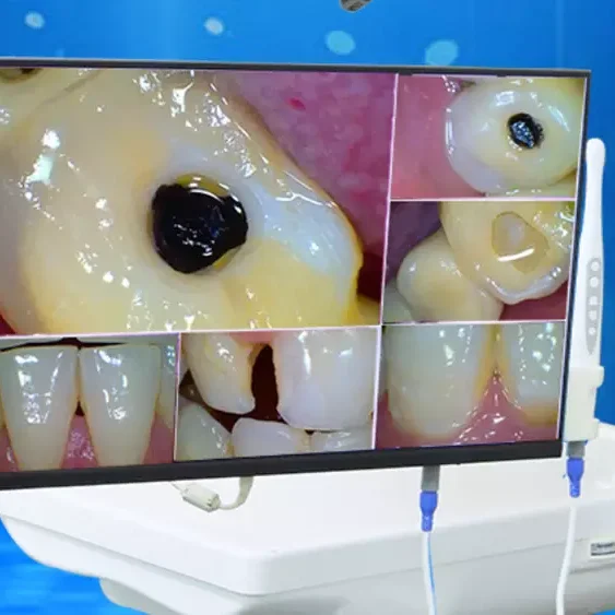 The most sold Computer HD Touch Screen Endoscopic Equipment Dental Wifi HD 1080P Intraoral Camera