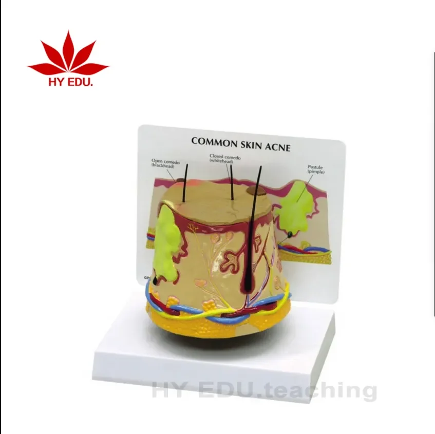 Medical science  biology  pathological skin acne anatomical  structure 3D diseased  model