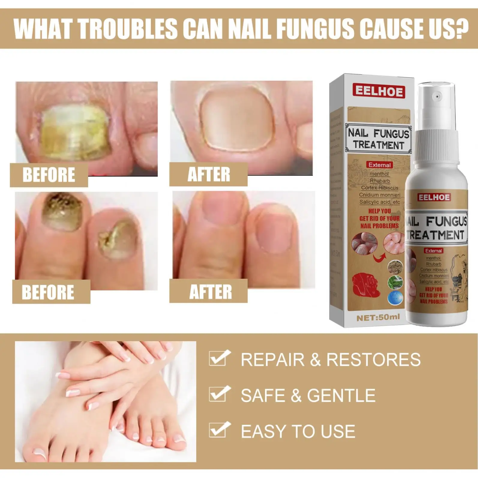 Costom Fungal Nail Repair Spray Nursing Treatment Anti-Infective Paronychia Onychomycosis Care  Foot Nail Fungus Removal Gel