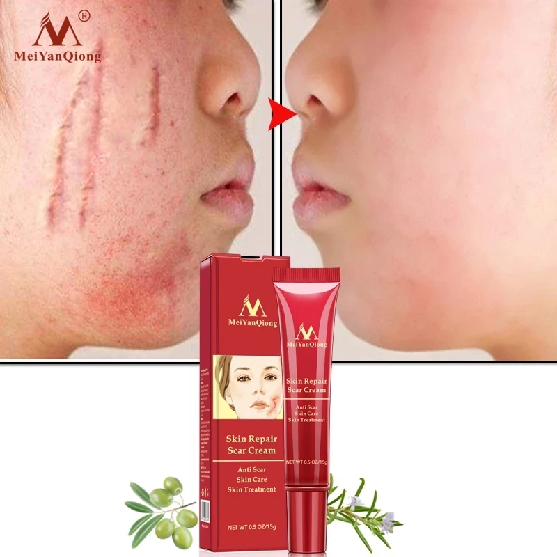 Hot Sale Skin Care Anti Scar Treatment For Old Scars On Legs And Face