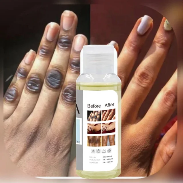 Private Label Extra Strong Peeling Knuckle Oil Whitening Yellow Peeling Oil