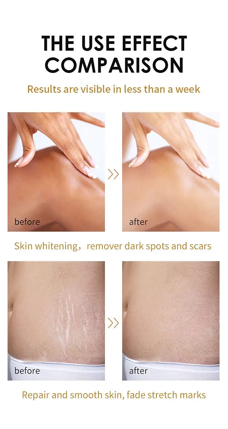 Stretch Marks Skin Peeling Oil extra Strong Whitening Yellow Peeling Oil Peeling Oil for Hand Body Leg
