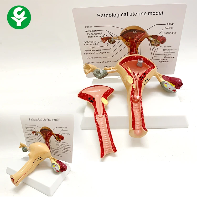 Standard price medical anatomical uterus teaching models of the uterine leiomyomas