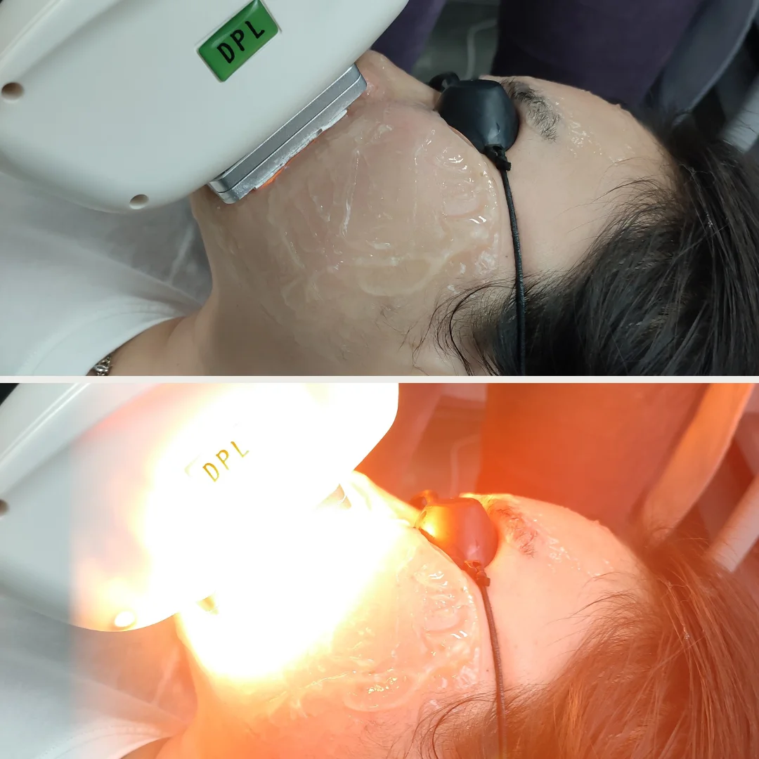 GOMECY-Multifunction-beauty-machine-3-in-1-elight-ipl-opt-rf-nd-yag-ipl-laser-hair-in-Beijing
