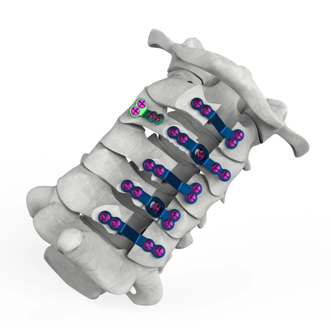 Dome Open Door Lateral Hole Plate Titanium Posterior Cervical Laminoplasty plate fixation system Spine Orthopedic