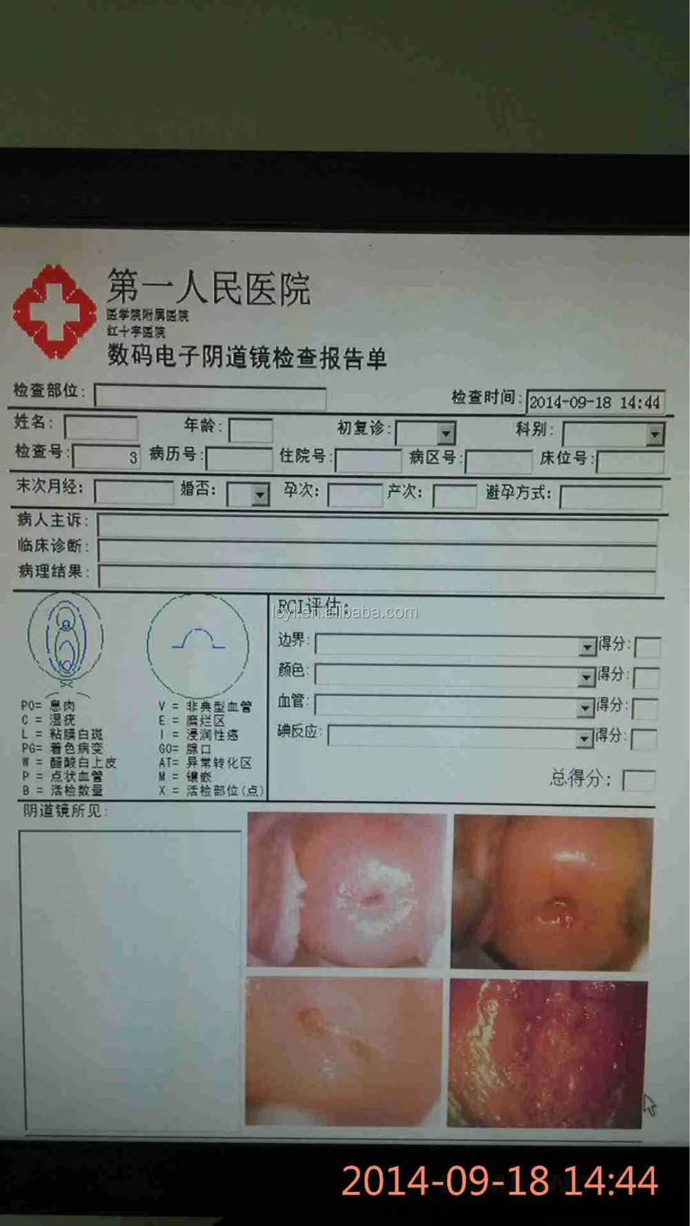 Hospital professional Medical System Specialized Digital Optical Colposcope