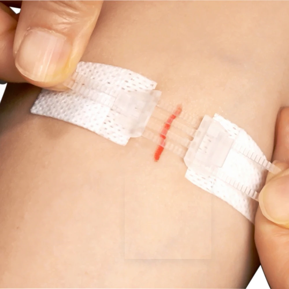 Cobalt60 Sterile reinforced medical wound skin closure strip