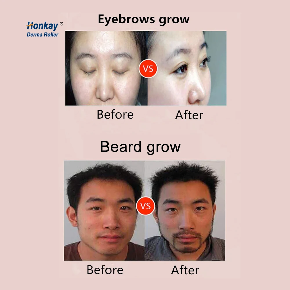 Hair Transplant Kit Instrument Implantor Follicle Implant Pen Tool Hair Implant Hair Transplant Machine