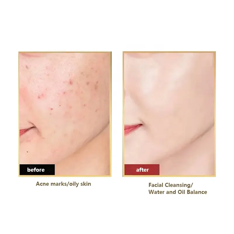 5% Benzoyl Peroxide Hyaluronic Acid Custom Gentle Clean Repair Sensitive Skin Acne Foaming Facial Cleanser Face Wash