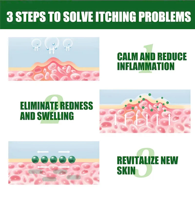 OEM/ODM Services Eczema Pruritus Psoriasis Skin Antipruritic