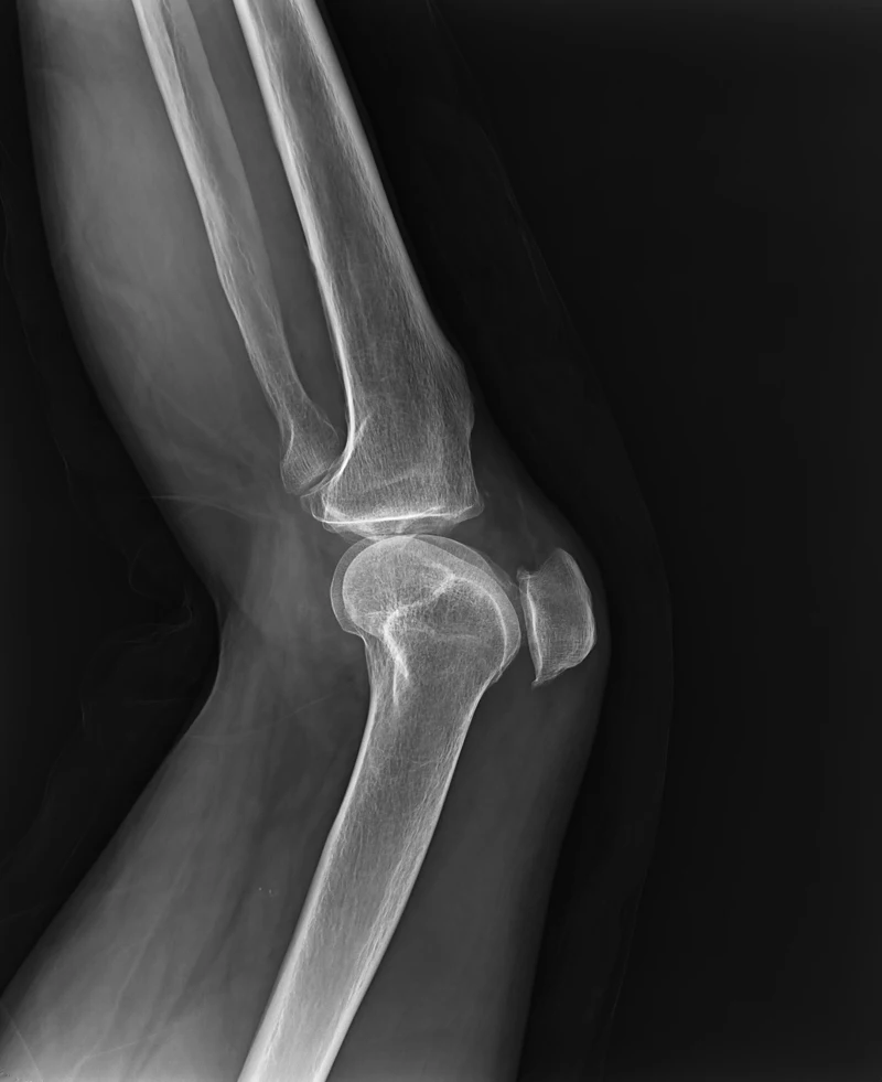 Medical Wired 17*17 Fix Mounted Digital Flat Panel Detector X Ray DR  for Human and Veterinary Diagnostic Radiography