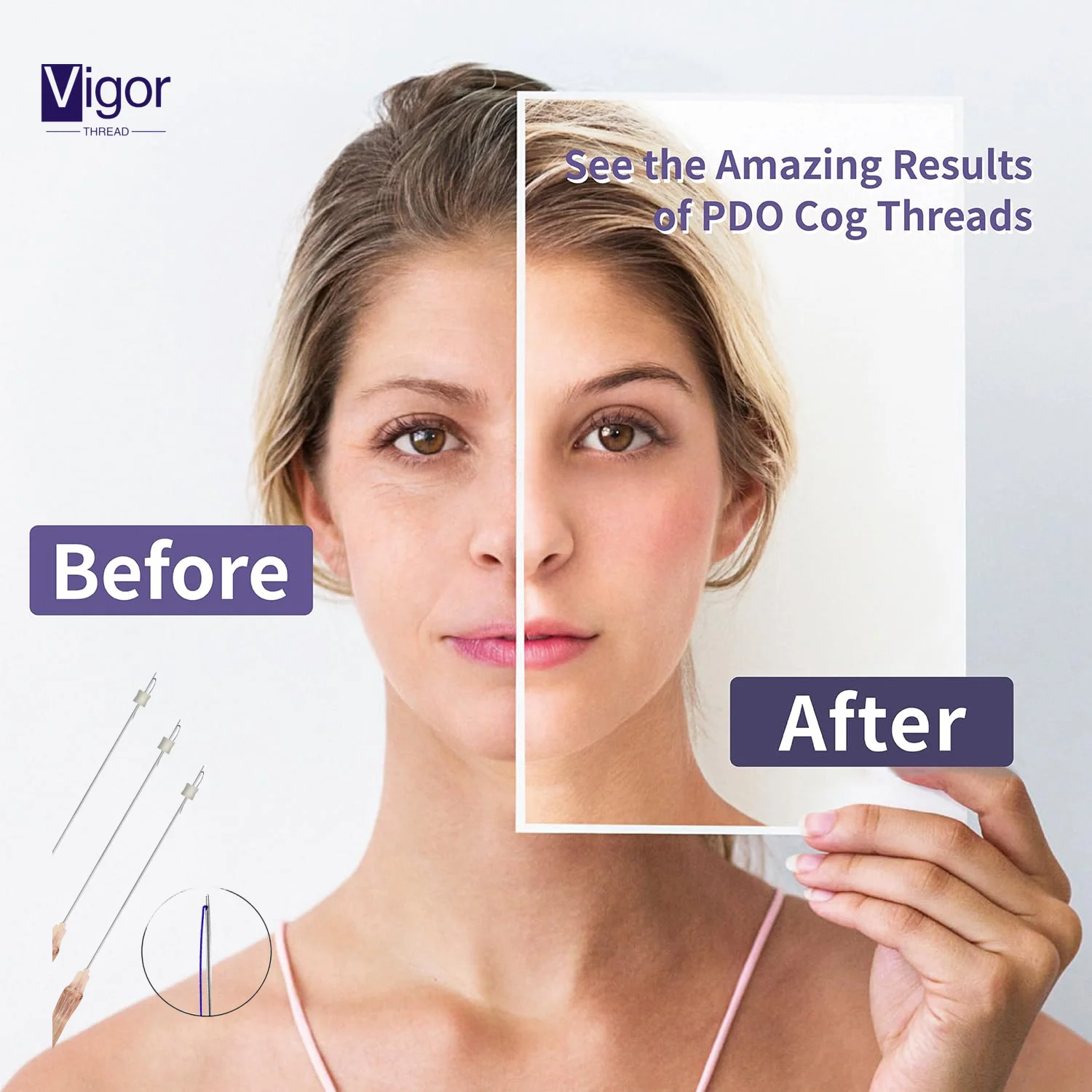 VIGOR wholesale hilos pdo lifting threads korean hilos fishbone mono cog thread lift 8d 18g 100mm korea pdo 3d thread tensioners