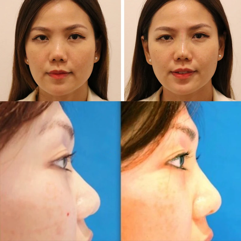 amazing noninvasive anti-aging aptos made korea reshaping v lift cannula cosmetic grade nose thread pdo