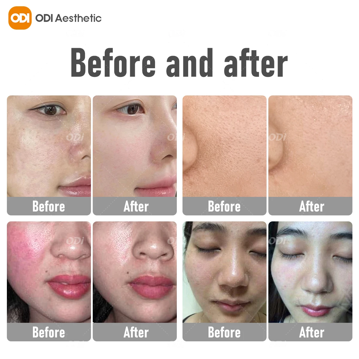 Oxygen Jet Peel Skin Rejuvenation Oxigen Facial Machine O2 Hyperbaric Oxygenation Dome Hydro Oxygen Facial Machine