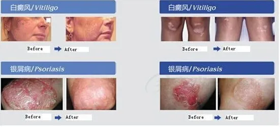  UVB лампы псориаза 311нм Лазерная УФ фототерапия для