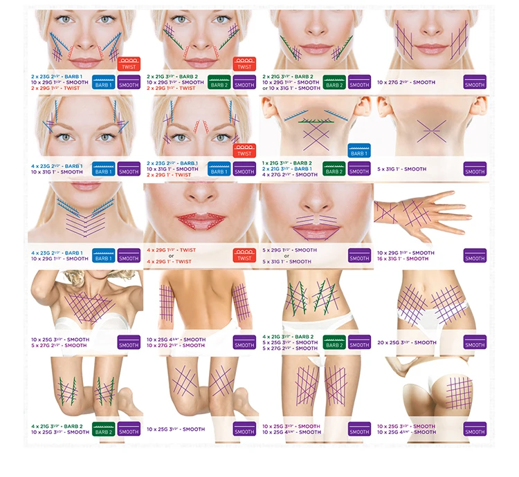 pcl thread mono 30g25mm for under eye wrinkles eye bag treatment