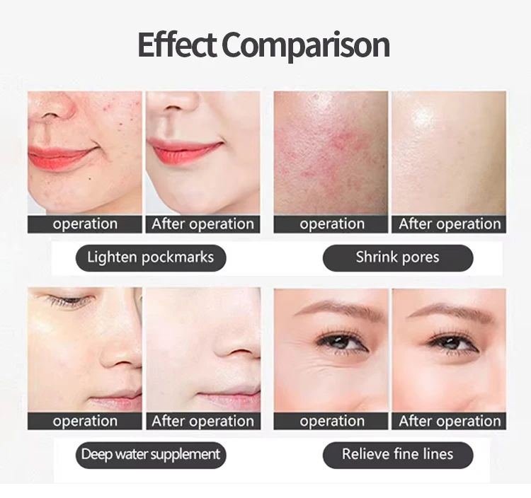 Good Effect Pdt Led Light Therapy Acne Treatment Skin Care Device Red Light Therapy Body Whitening Face Ance Facial Led Machine