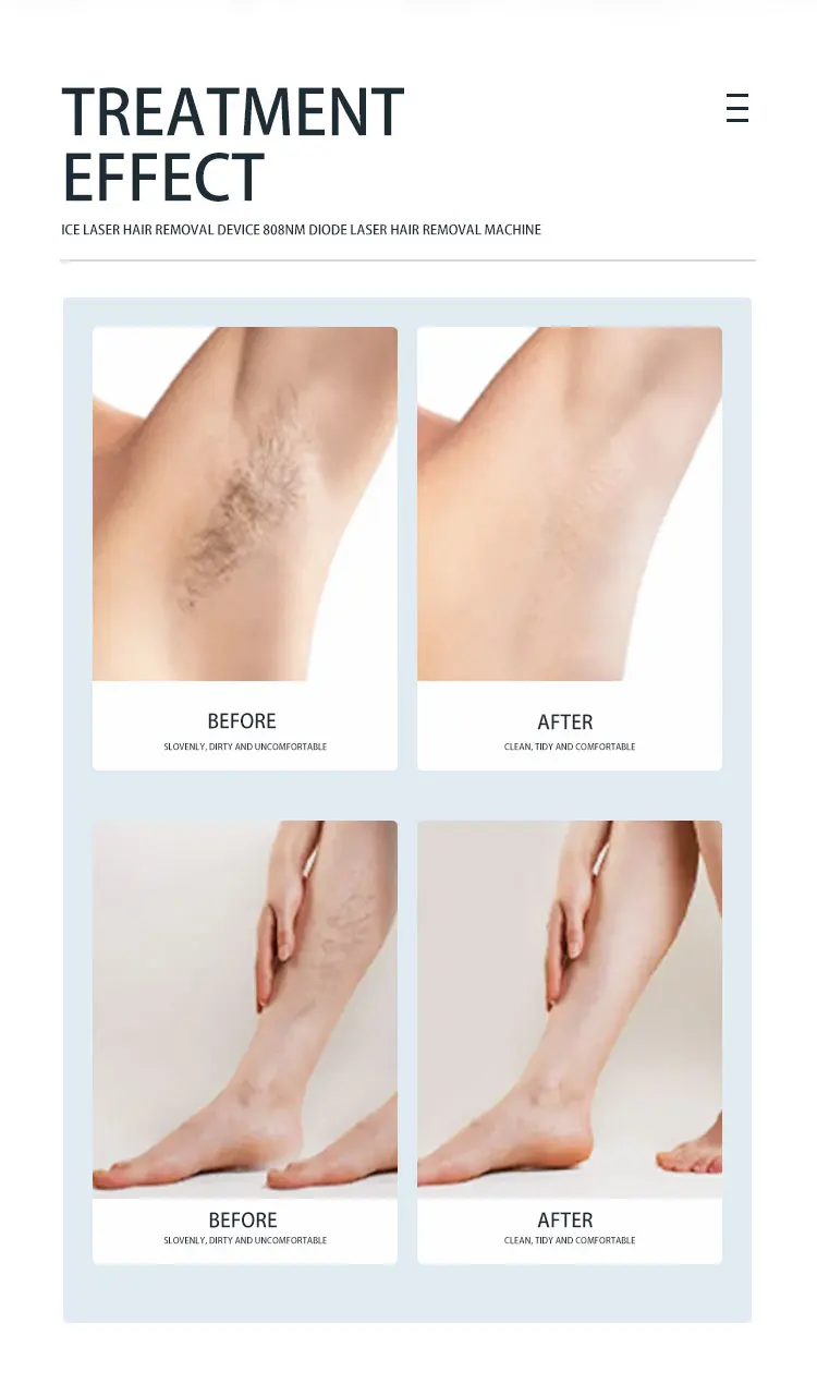 2024 Newest Unique Design Professional  3 wavelength diode laser hair removal machine Strong power and energy Diode laser