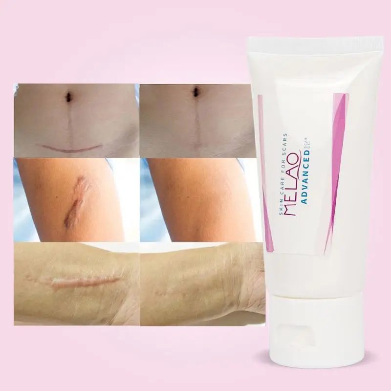 private label free sample Scar and anti acne mark removal gel ointment silicone advanced  silicone Scar Remover Gel