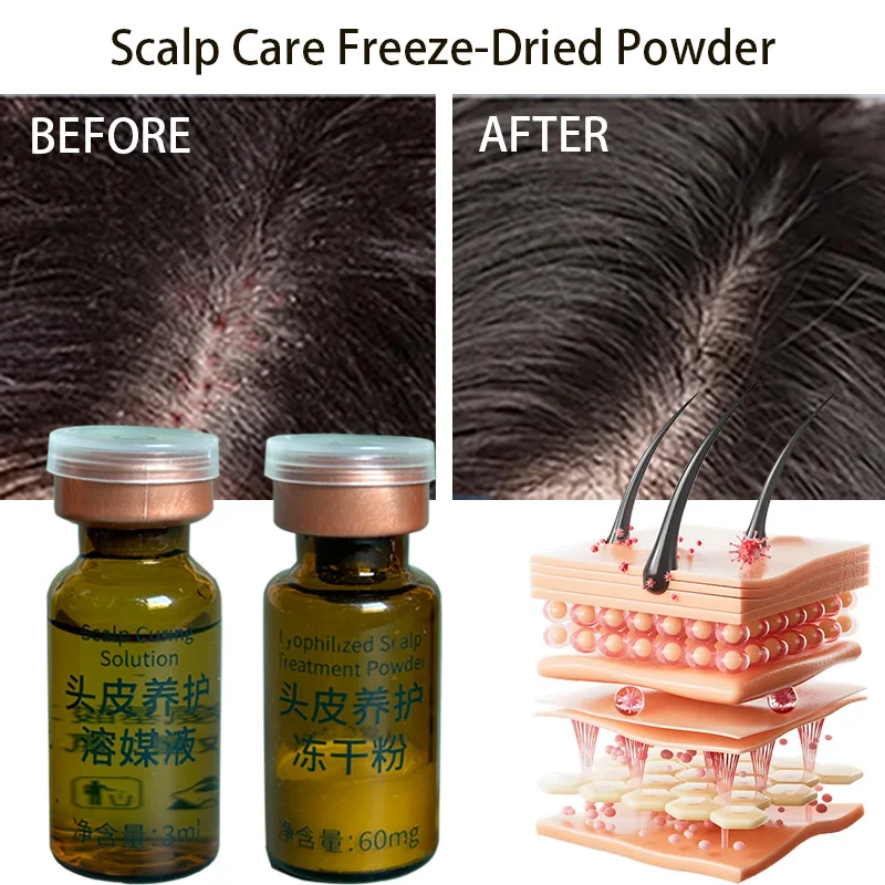 Lyophilized Scalp Treatment Powder Hair Care Lyophilized Powder Hair care Anti-itch and anti-dandruff Scalp care Powder