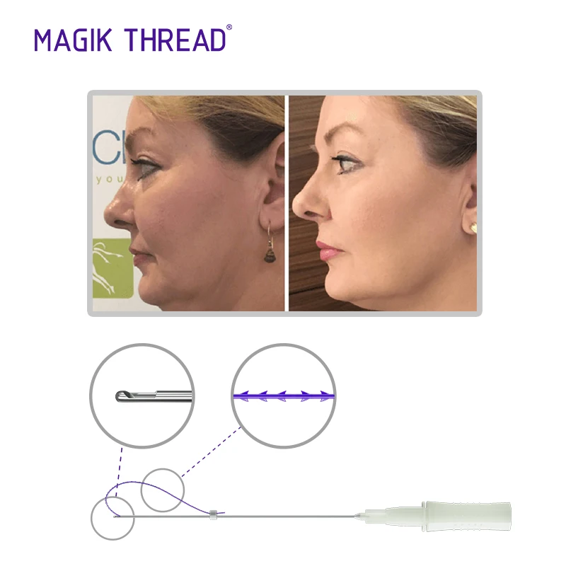 Magik Thread fios 18g cog v line lift pdo molding cog thread for face and body