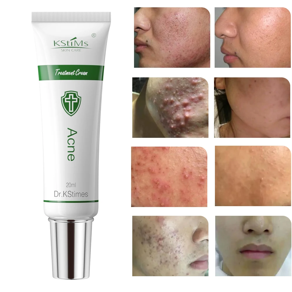 World Best Selling Korean Acne Face Cream for Acne and Pimples Treatment Anti Acne Facial Cream