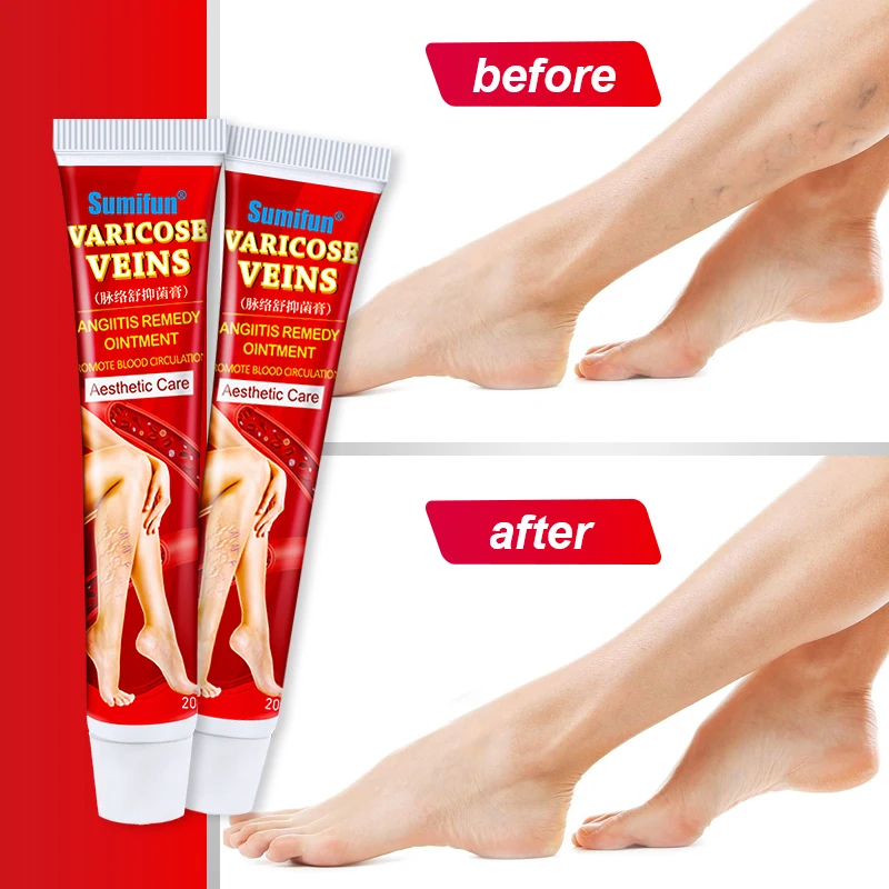 Sumifun New Varicose Veins Treatment Cream 100% Original Vasculitis Phlebitis Spider Pain Relief Ointment Medical Plaster