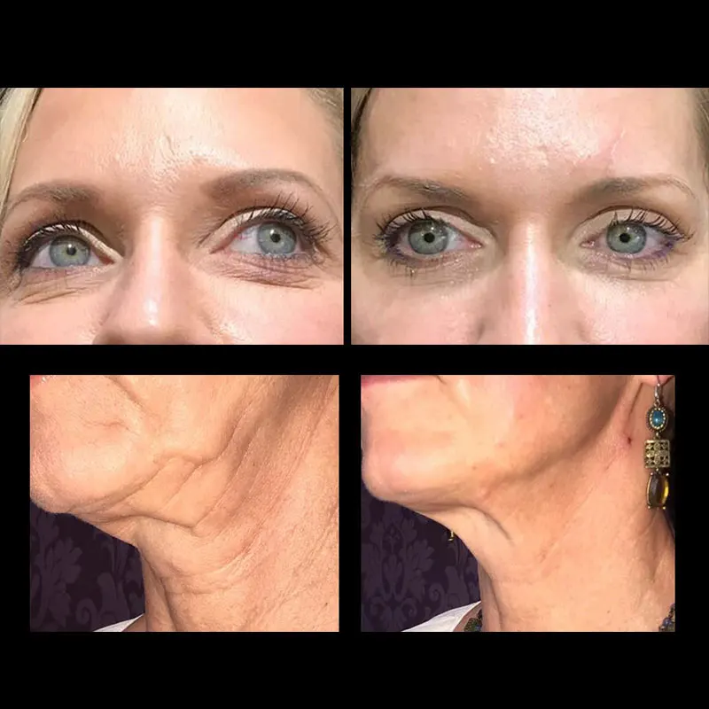 Лидер продаж, 4d 18 г 21 г, тупый Тип ПДО, резьбовой подъемник с иглой cannula для лифтинга лица