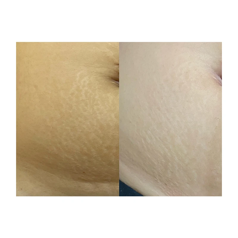 SEASON DER High-end custom Remove Stretch Marks White Freckles Vitiligo Pigments Skin private label permanent makeup pigment