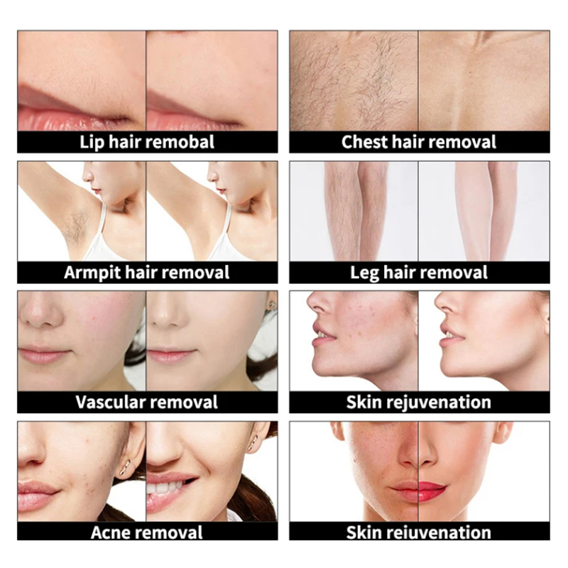 New laser hair removal machines Ipl Laser Skin Rejuvenation Vascular Removal Ipl Dpl laser hair remove Machine