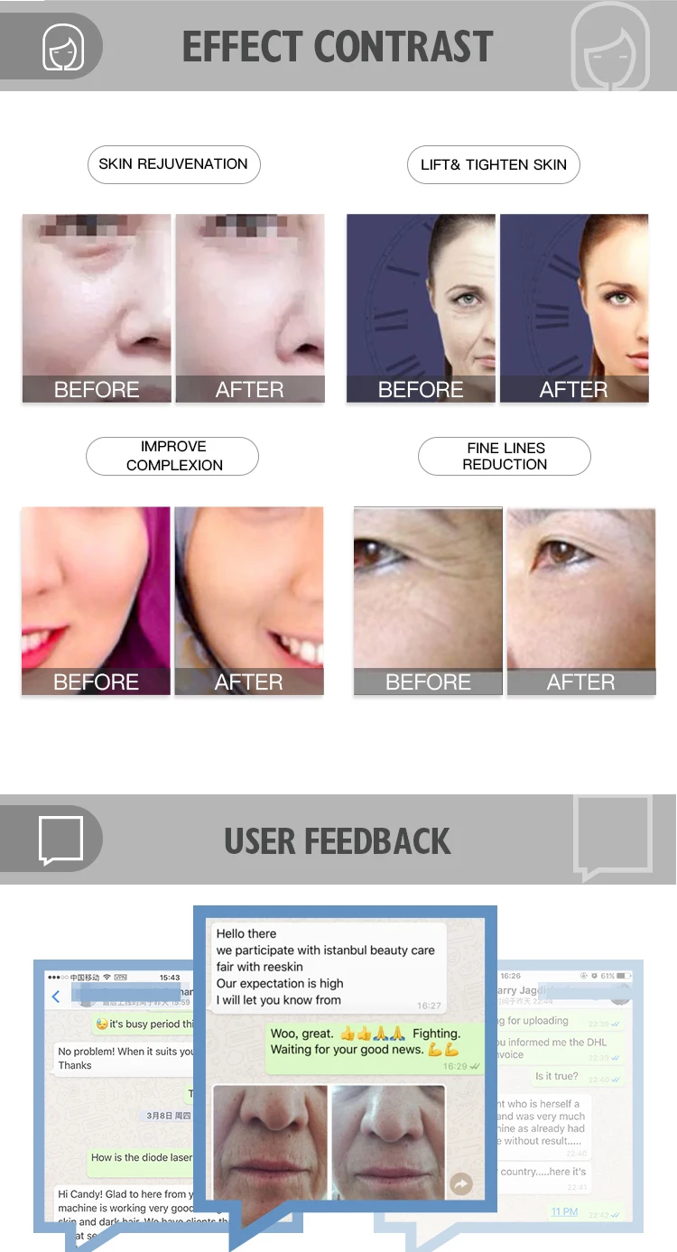 Rf Facial Beauty Machine Face Lifting Rf Fractional Needle Wrinkle Removal Rf Microneedle Machine