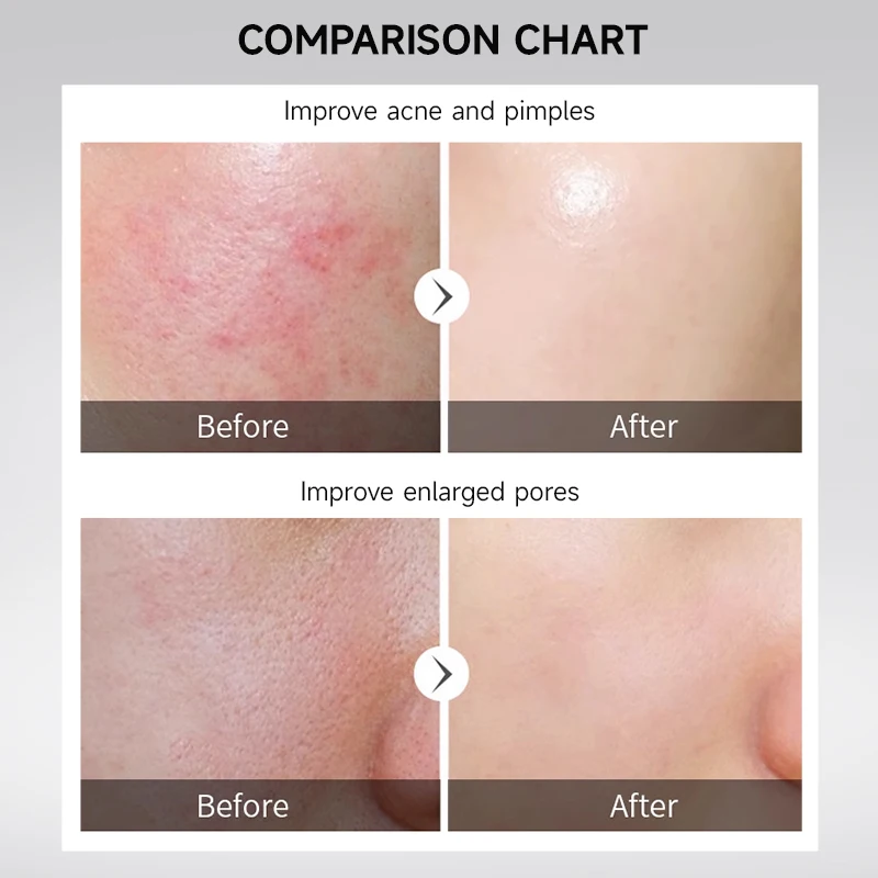 Private  Label High quality and stable AHA + BHA Facial Peeling And Anti-acne aha Serum